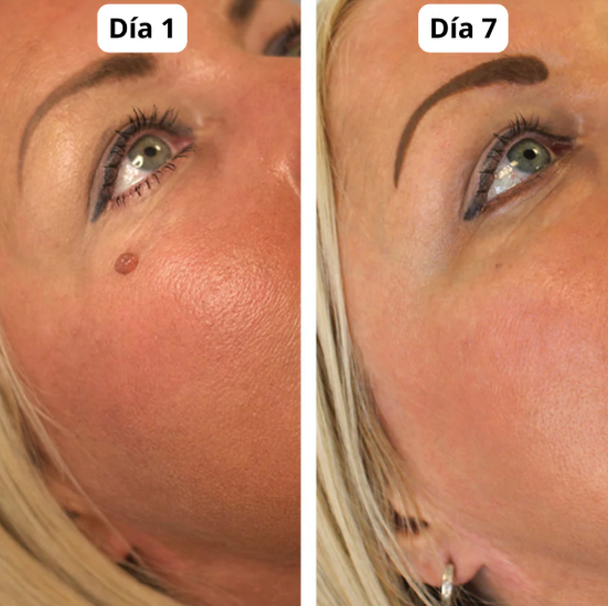 REMOVEDOR DE VERRUGAS +OBSEQUIO GRATIS CREMA DE ABEJA🧴🐝