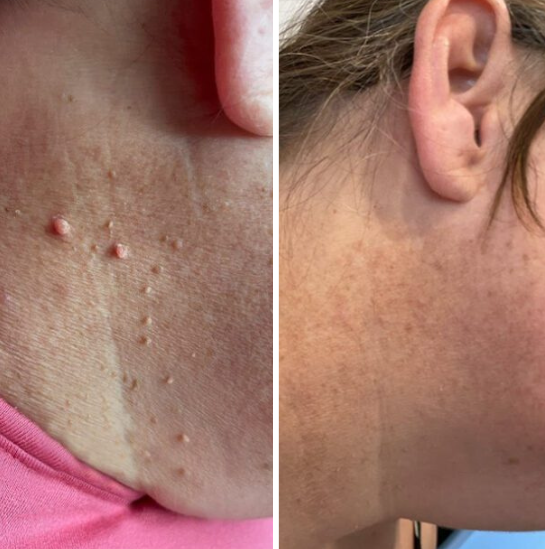 REMOVEDOR DE VERRUGAS +OBSEQUIO GRATIS CREMA DE ABEJA🧴🐝